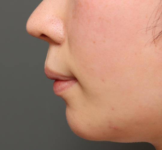 20代女性の人中短縮（リップリフト） Before 症例写真