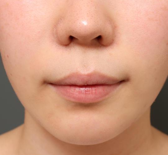 20代女性の人中短縮（リップリフト） Before 症例写真