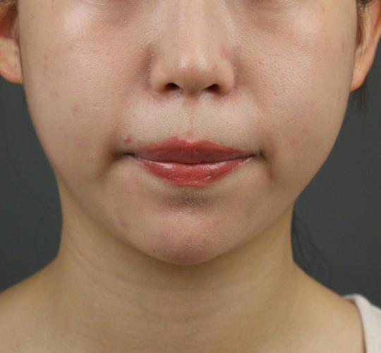 20代女性のヒアルロン酸注射（アゴ形成） After 症例写真