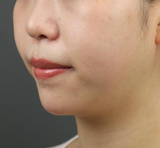 20代女性のシワ・たるみ After 症例写真