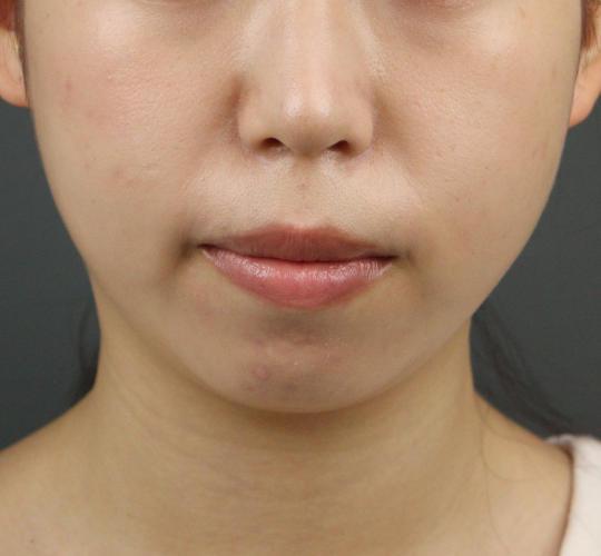 20代女性のヒアルロン酸注射（アゴ形成） Before 症例写真
