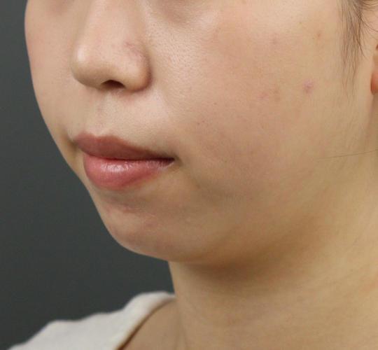 20代女性のシワ・たるみ Before 症例写真