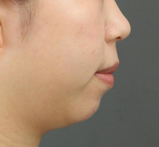 20代女性のヒアルロン酸注射（アゴ形成） Before 症例写真