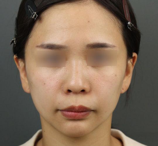 20代女性のエラ・アゴ・小顔 After 症例写真