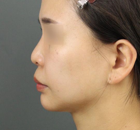 20代女性のヒアルロン酸注射（ほうれい線） After 症例写真