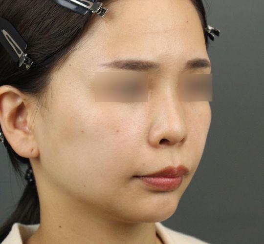 20代女性のヒアルロン酸注射（ほうれい線） After 症例写真