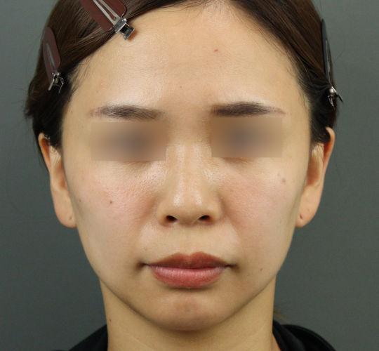 20代女性のエラ・アゴ・小顔 Before 症例写真