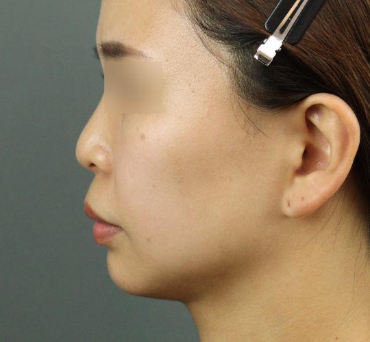 20代女性のヒアルロン酸注射（ほうれい線） Before 症例写真