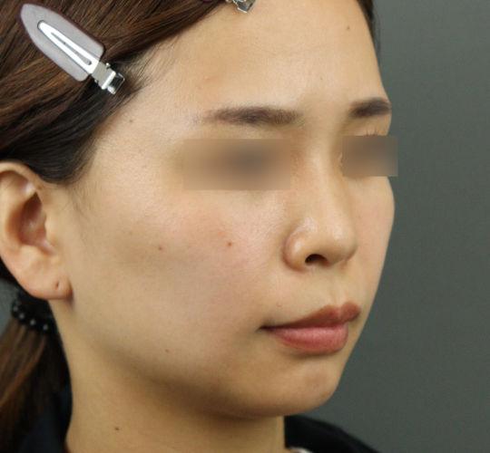 20代女性のヒアルロン酸注射（ほうれい線） Before 症例写真