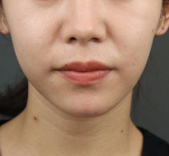 20代女性のヒアルロン酸注射（アゴ形成） After 症例写真