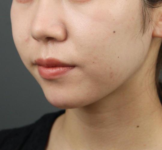20代女性のヒアルロン酸注射（アゴ形成） After 症例写真