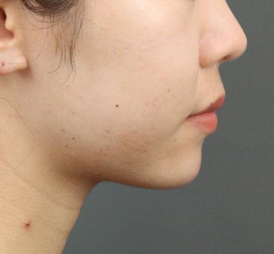 20代女性のヒアルロン酸注射（アゴ形成） After 症例写真