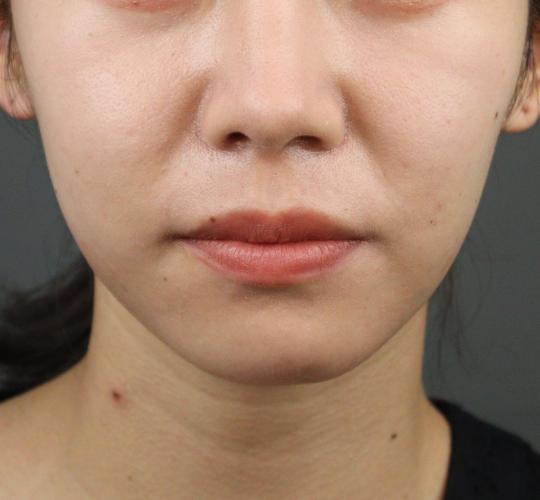 20代女性のヒアルロン酸注射（アゴ形成） Before 症例写真