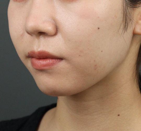20代女性のヒアルロン酸注射（アゴ形成） Before 症例写真