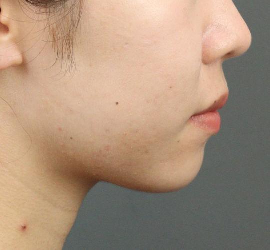 20代女性のヒアルロン酸注射（アゴ形成） Before 症例写真