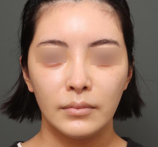 20代女性の人中短縮(リップリフト) After 症例写真