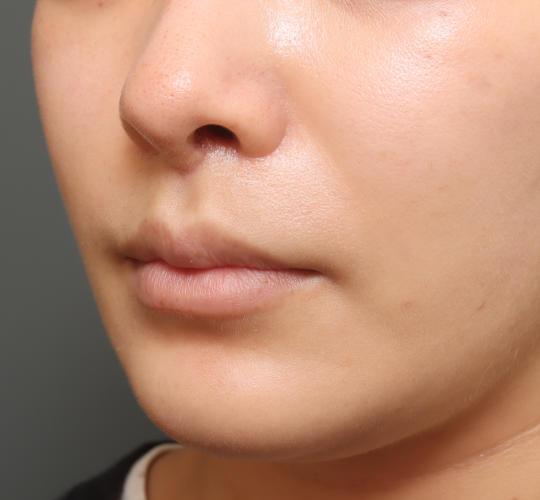 20代女性の人中短縮(リップリフト) After 症例写真