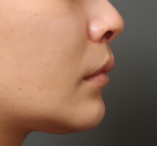 20代女性の人中短縮(リップリフト) After 症例写真