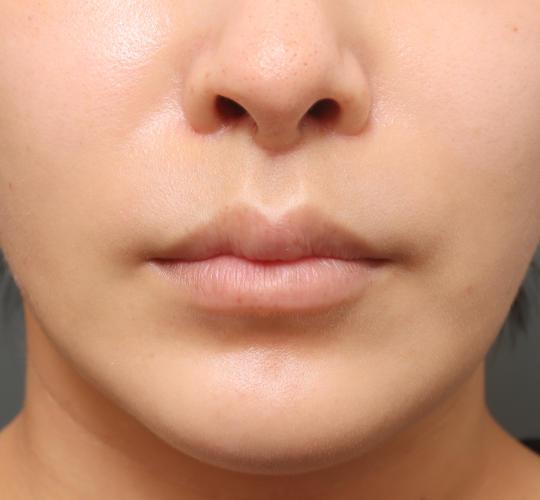 20代女性の人中短縮(リップリフト) After 症例写真