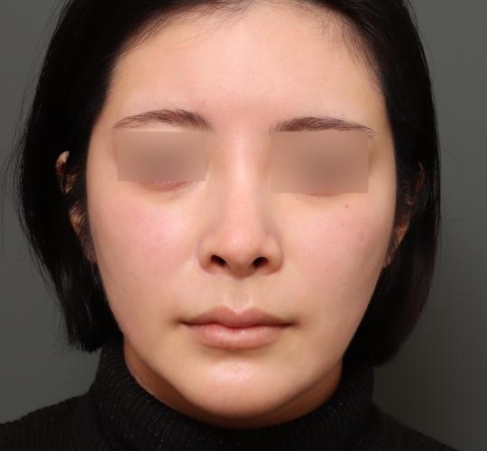 20代女性の人中短縮(リップリフト) Before 症例写真