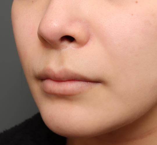 20代女性の人中短縮(リップリフト) Before 症例写真