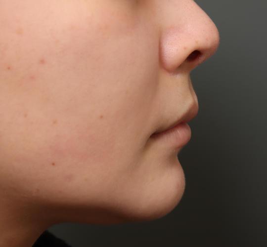 20代女性の人中短縮(リップリフト) Before 症例写真