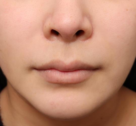 20代女性の人中短縮(リップリフト) Before 症例写真