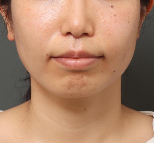 30代女性の人中短縮(リップリフト) After 症例写真