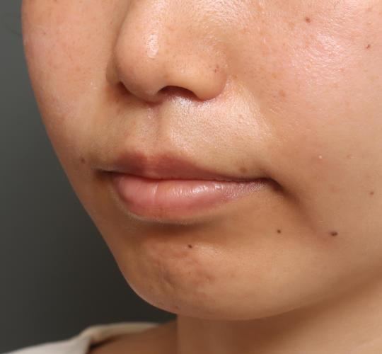 30代女性の人中短縮(リップリフト) After 症例写真