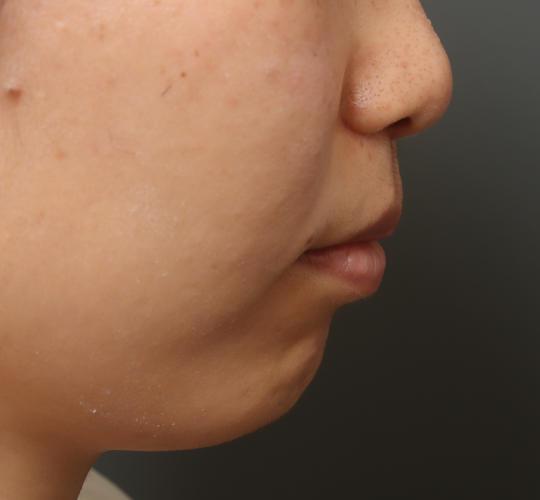 30代女性の人中短縮(リップリフト) After 症例写真