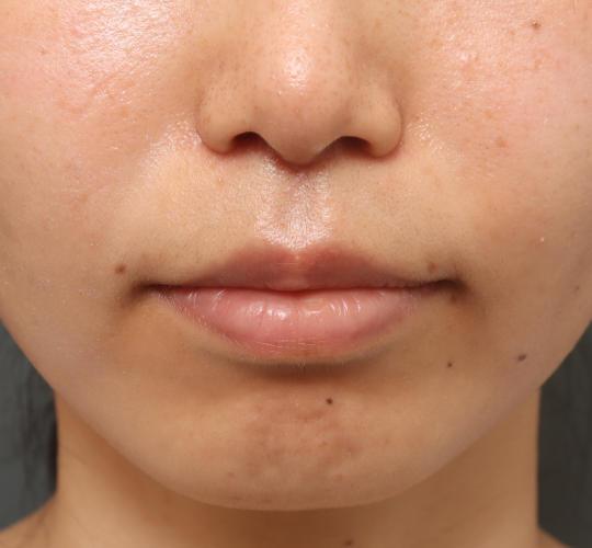 30代女性の人中短縮(リップリフト) After 症例写真