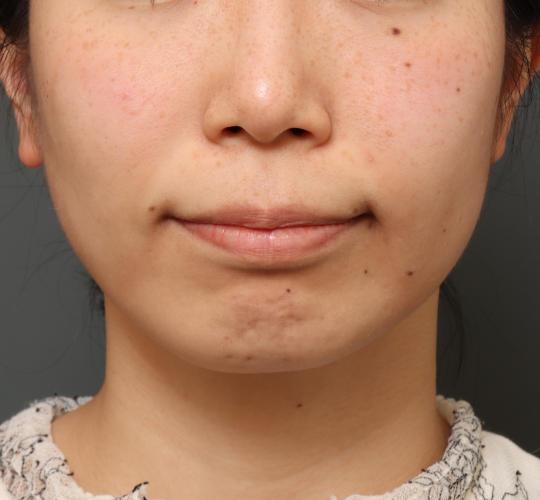 30代女性の人中短縮(リップリフト) Before 症例写真