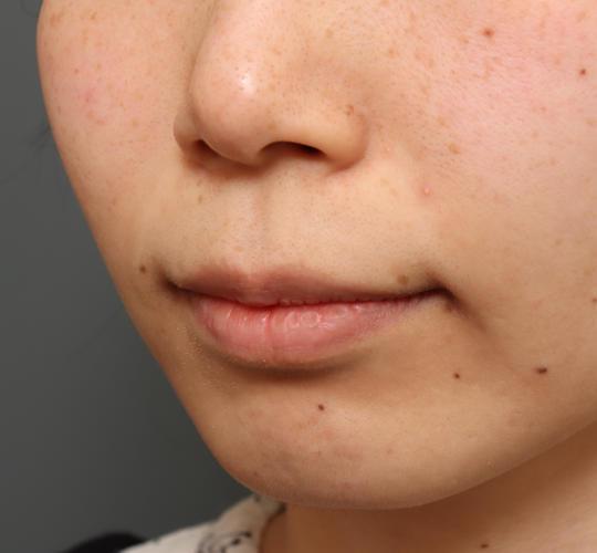 30代女性の人中短縮(リップリフト) Before 症例写真