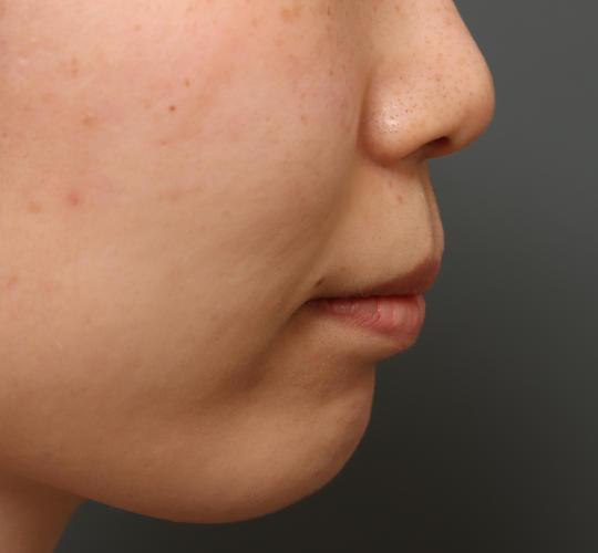 30代女性の人中短縮(リップリフト) Before 症例写真