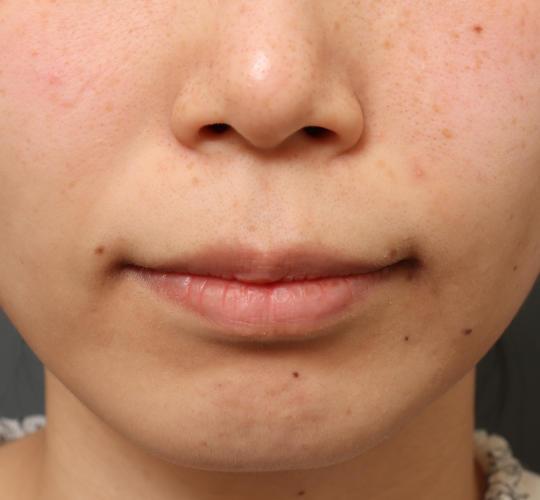 30代女性の人中短縮(リップリフト) Before 症例写真