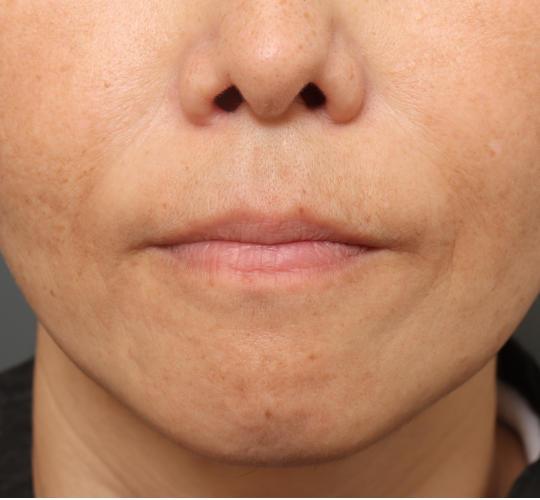 50代女性の再生医療（顔） After 症例写真