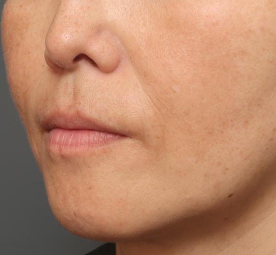 50代女性の真皮線維芽細胞療法 After 症例写真