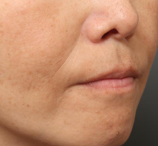 50代女性の真皮線維芽細胞療法 After 症例写真