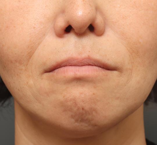 50代女性の再生医療（顔） Before 症例写真