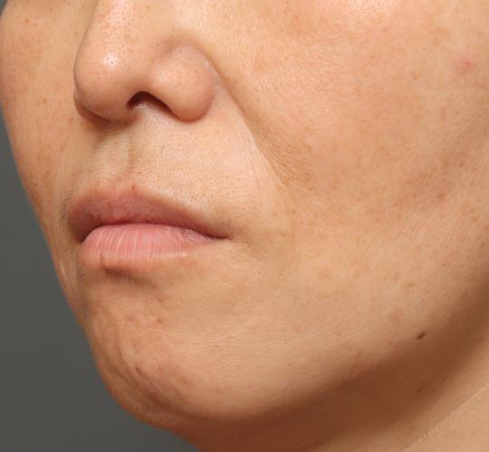 50代女性の真皮線維芽細胞療法 Before 症例写真