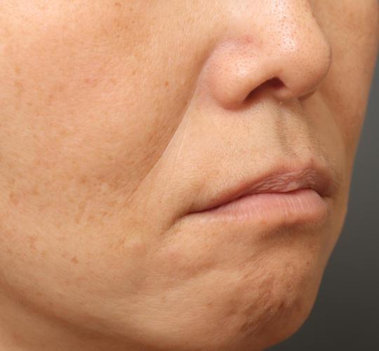 50代女性の真皮線維芽細胞療法 Before 症例写真