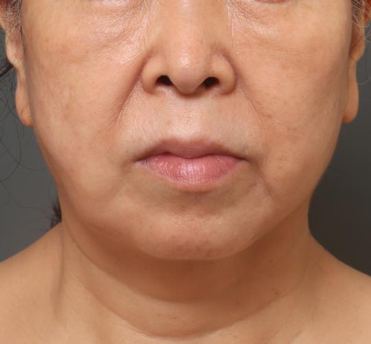 60代女性の真皮線維芽細胞療法 After 症例写真