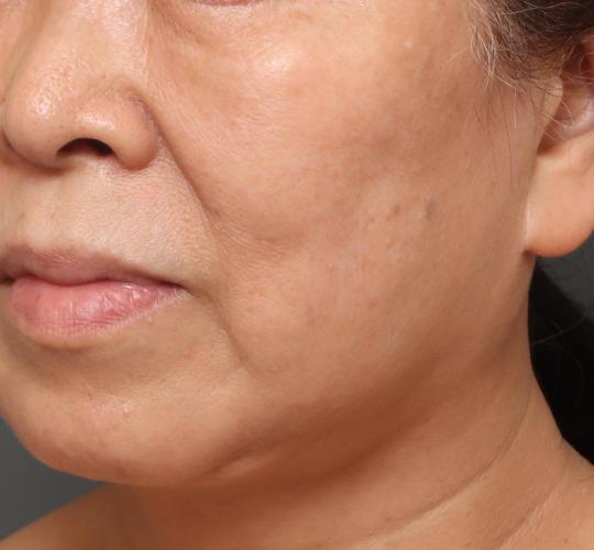 60代女性の再生医療（顔） After 症例写真