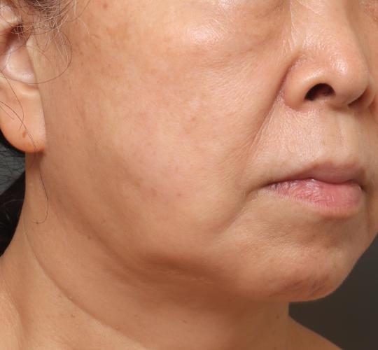 60代女性の真皮線維芽細胞療法 After 症例写真