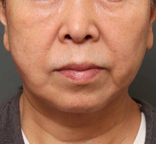 60代女性の真皮線維芽細胞療法 Before 症例写真