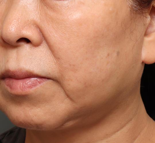 60代女性の再生医療（顔） Before 症例写真