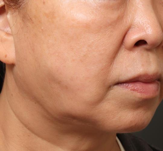 60代女性の真皮線維芽細胞療法 Before 症例写真