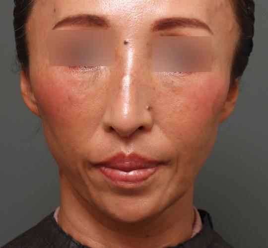 50代女性の人中短縮（リップリフト） After 症例写真