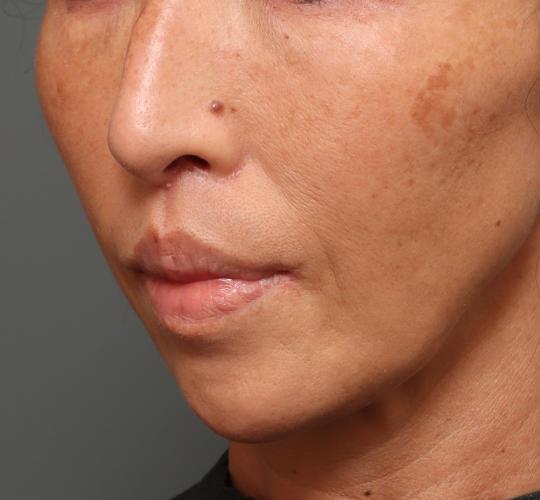 50代女性の人中短縮(リップリフト) After 症例写真