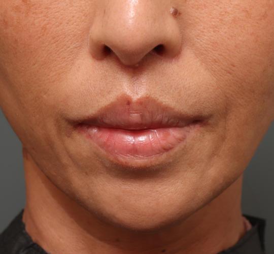 50代女性の人中短縮（リップリフト） After 症例写真